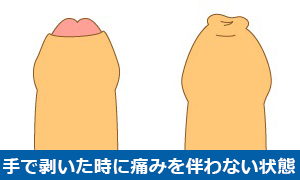 仮性包茎