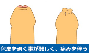 真性包茎