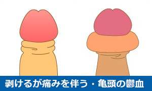 カントン包茎