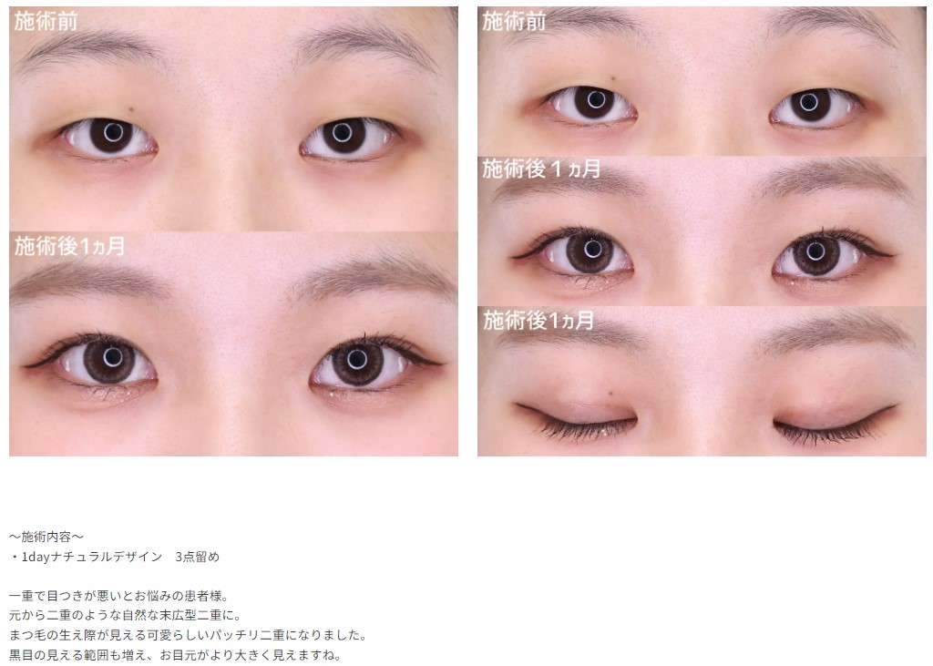 TA式二重術症例①