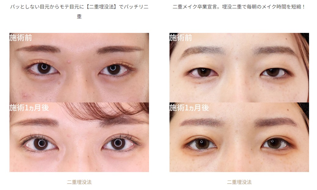 TA式二重術症例⑤
