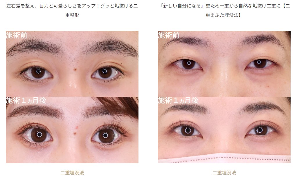 TA式二重術症例⑥
