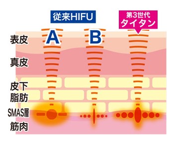 第3世代タイタンとその他の機器との違い