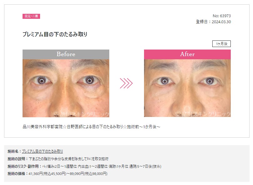目の下のふくらみ取り プレミアム①