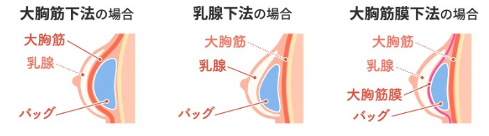 バッグを挿入する手法