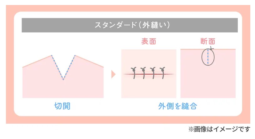 TAクリニック大陰唇たるみ解消術①