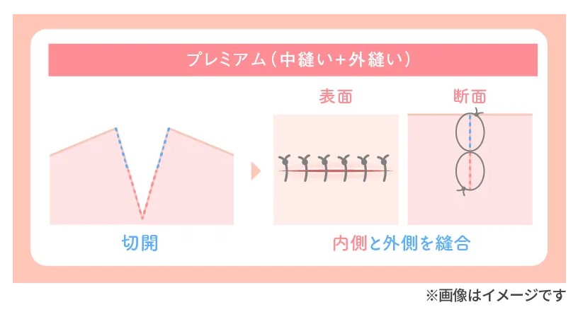 TAクリニック大陰唇たるみ解消術②