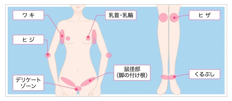 ピンクインティメイト適用範囲