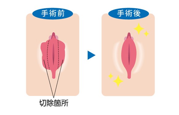 小陰唇縮小術施術前後