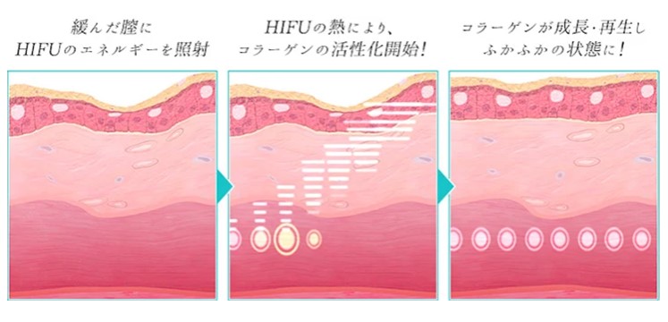 ハイフ機器