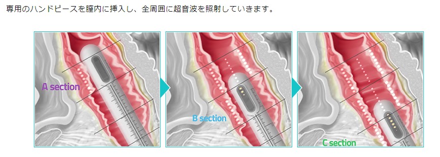 セクション深達度の詳細