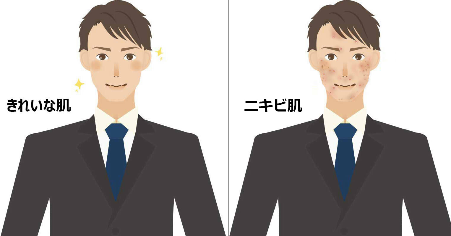 ニキビイラスト