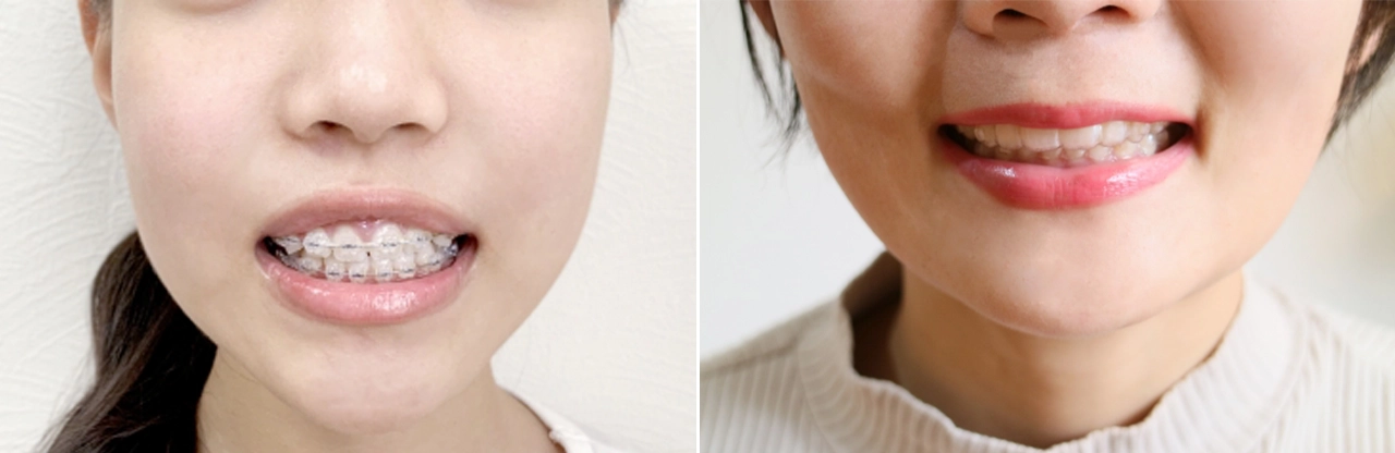 「固定式」か「着脱式」