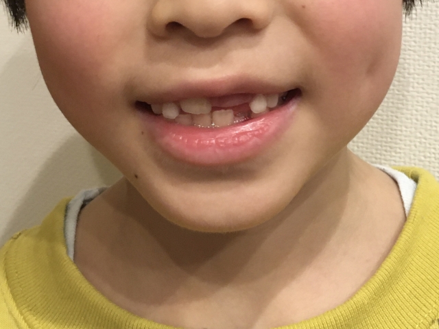 歯の大きさがバラバラな子供